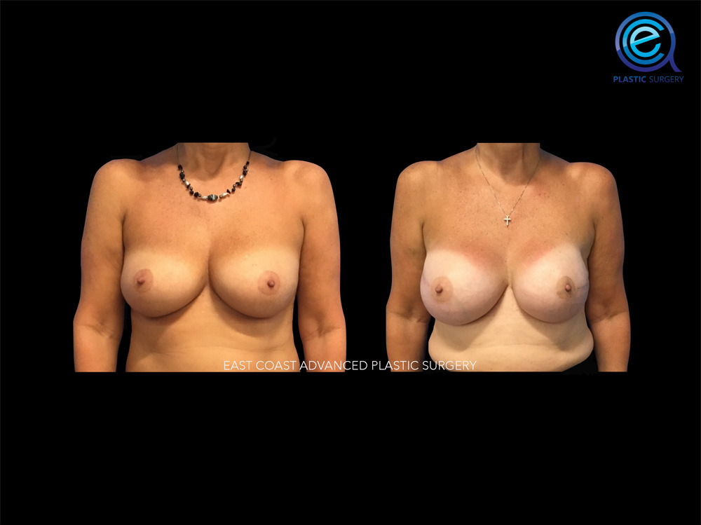 Real patient Breast Reconstruction by ECA Plastic Surgery, New Jersey