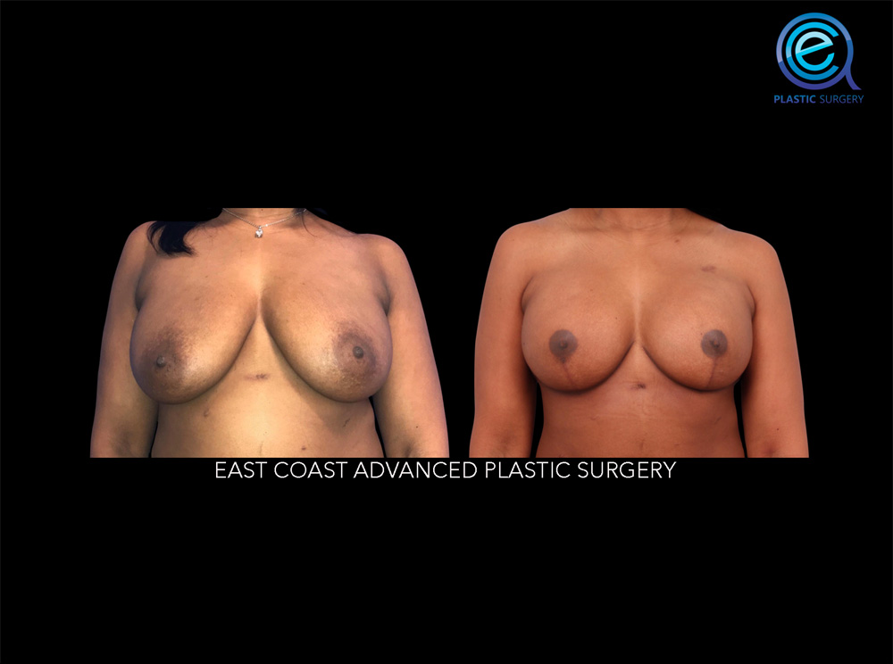 Real patient Breast Reconstruction by ECA Plastic Surgery, New Jersey