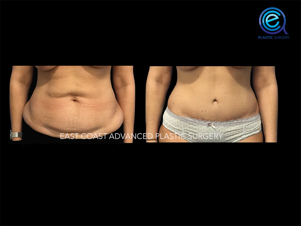 Real patient Abdominoplasty Tummy Tuck by ECA Plastic Surgery, New Jersey