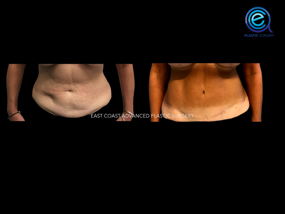 Real patient Abdominoplasty Tummy Tuck by ECA Plastic Surgery, New Jersey