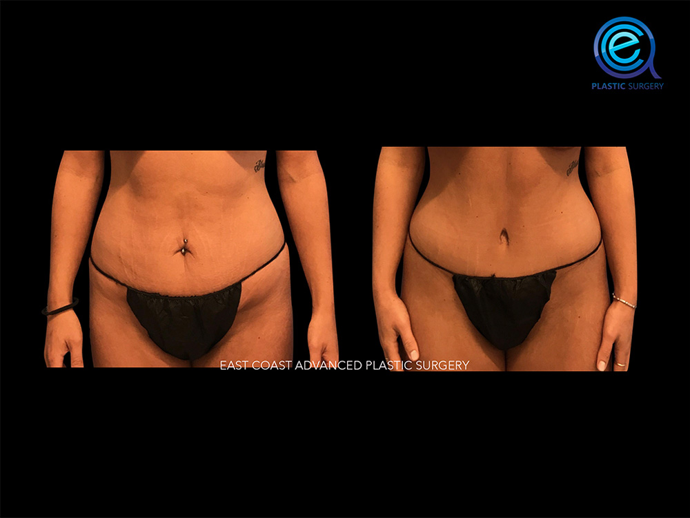 Real patient Abdominoplasty Tummy Tuck by ECA Plastic Surgery, New Jersey