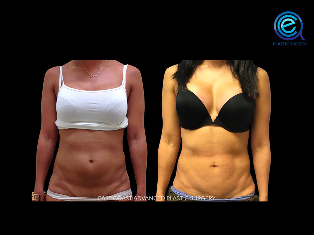 Real patient Abdominoplasty Tummy Tuck by ECA Plastic Surgery, New Jersey