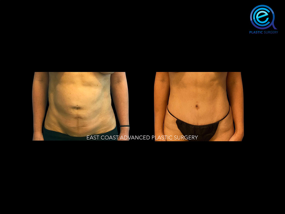 Real patient Abdominoplasty Tummy Tuck by ECA Plastic Surgery, New Jersey