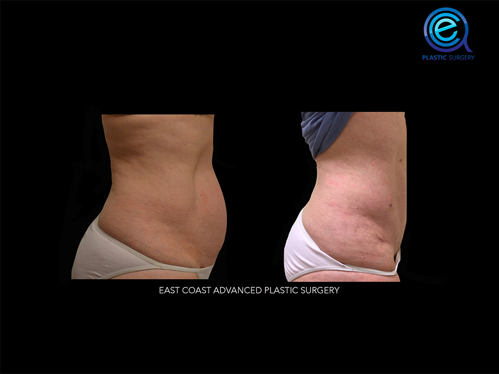 Real patient Abdominoplasty Tummy Tuck by ECA Plastic Surgery, New Jersey