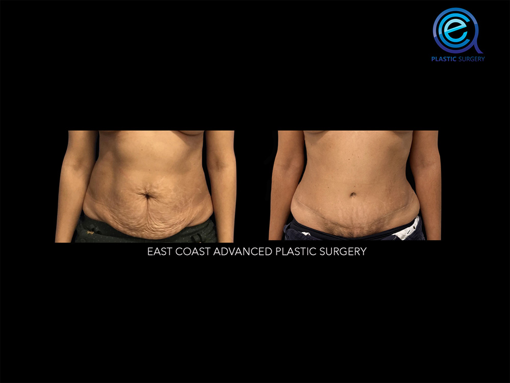 Real patient Abdominoplasty Tummy Tuck by ECA Plastic Surgery, New Jersey