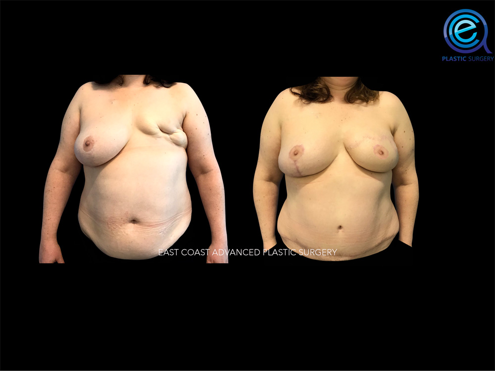 Real patient Breast Reconstruction by ECA Plastic Surgery, New Jersey
