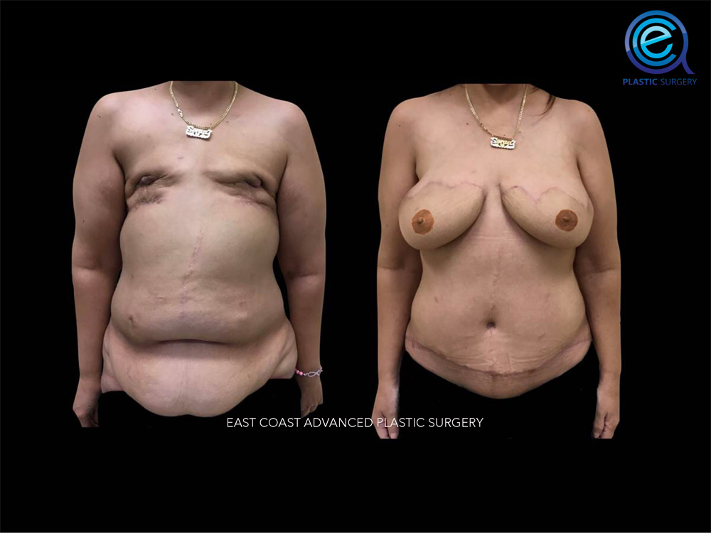 Real patient Breast Reconstruction by ECA Plastic Surgery, New Jersey