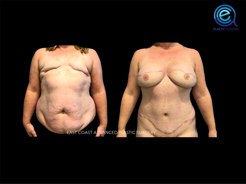 Real patient Breast Reconstruction by ECA Plastic Surgery, New Jersey