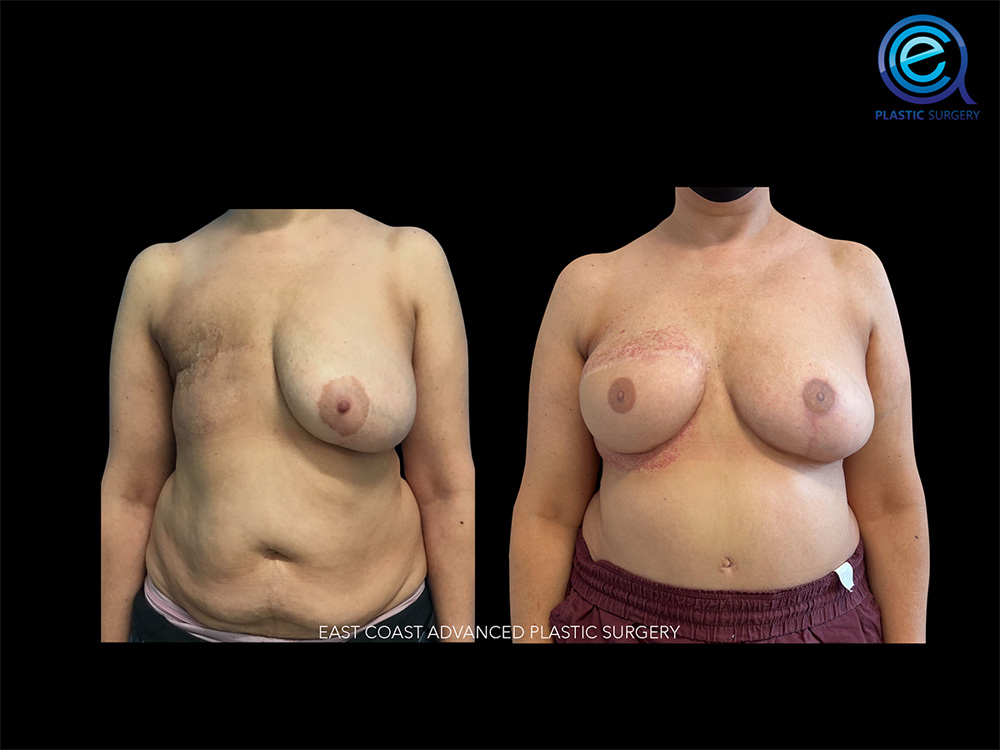Real patient Breast Reconstruction by ECA Plastic Surgery, New Jersey