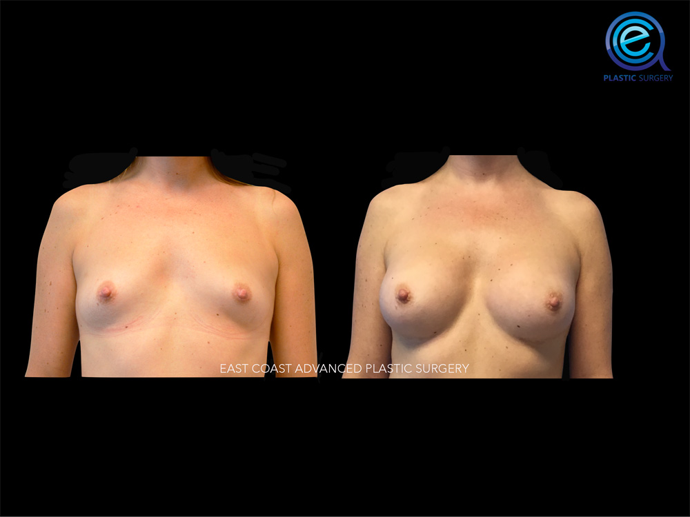 Real patient Breast Augmentation by ECA Plastic Surgery, New Jersey