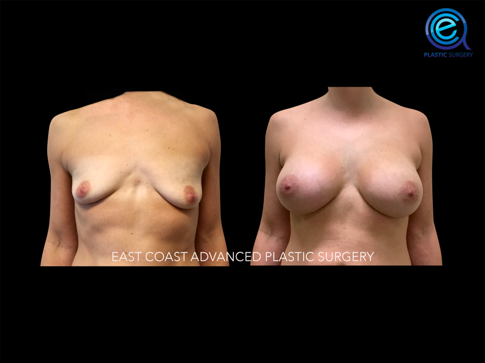 Real patient Breast Augmentation by ECA Plastic Surgery, New Jersey