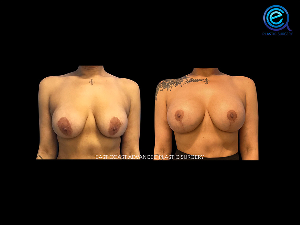 Real patient Breast Augmentation by ECA Plastic Surgery, New Jersey