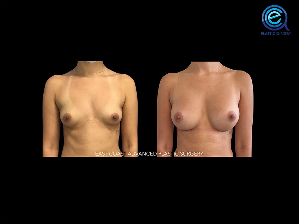Real patient Breast Augmentation by ECA Plastic Surgery, New Jersey
