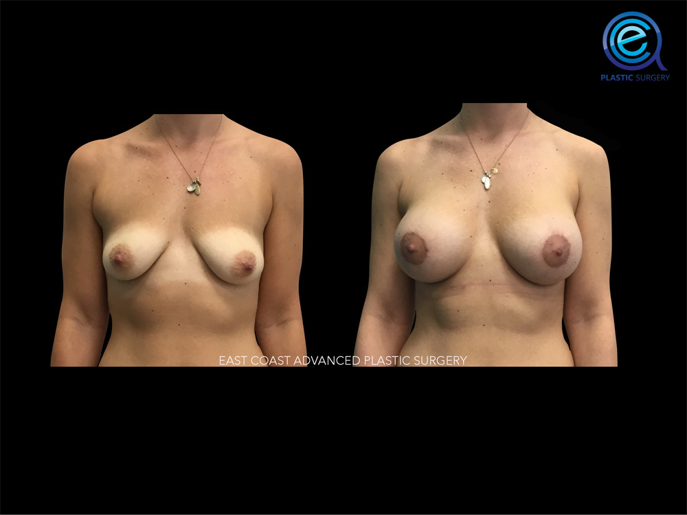 Real patient Breast Augmentation by ECA Plastic Surgery, New Jersey