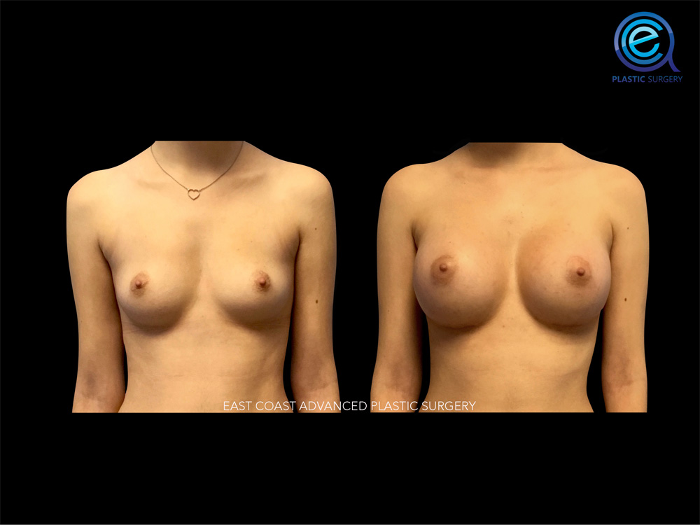 Real patient Breast Augmentation by ECA Plastic Surgery, New Jersey