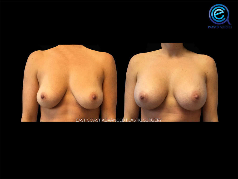 Real patient Breast Augmentation by ECA Plastic Surgery, New Jersey