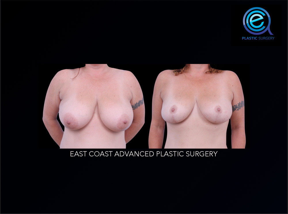 Real patient Breast Reconstruction by ECA Plastic Surgery, New Jersey