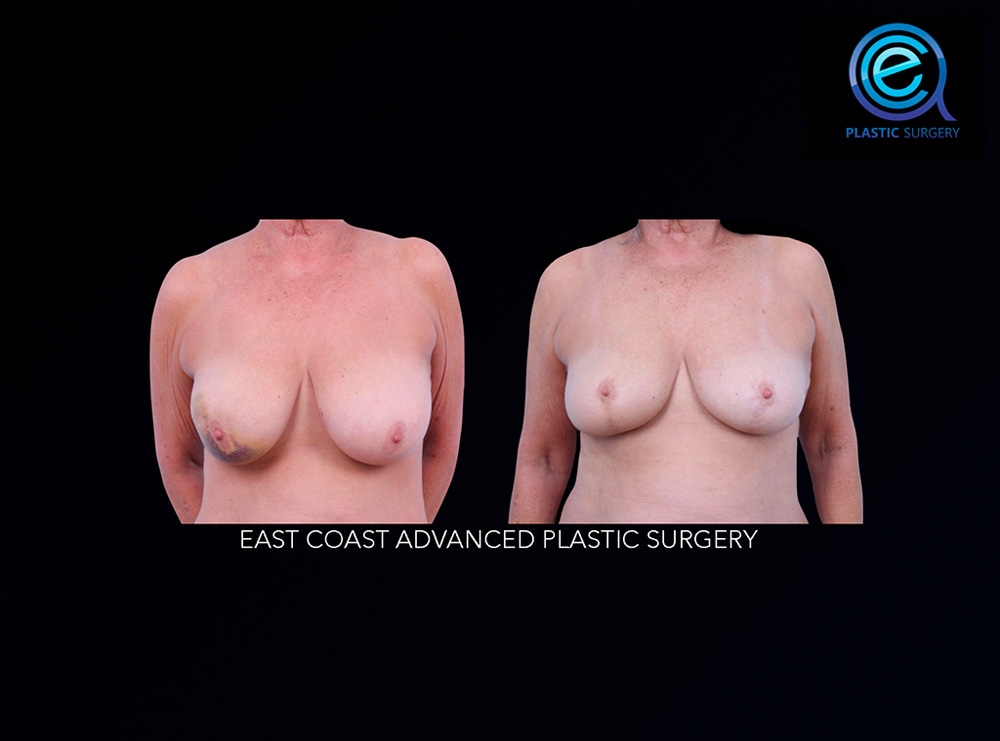 Real patient Breast Reconstruction by ECA Plastic Surgery, New Jersey