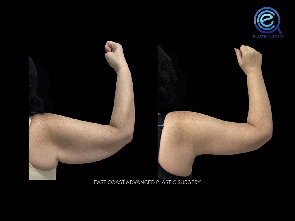 Real patient Brachioplasty Arm Lift by ECA Plastic Surgery, New Jersey